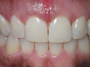 Cosmetic gingival countouring - after