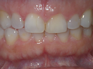 Cosmetic gingival countouring - before