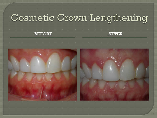 Cosmetic Crown Lengthening