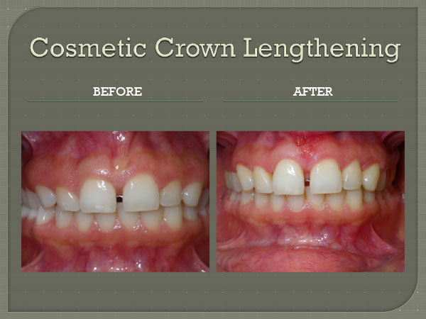Cosmetic Crown Lengthening