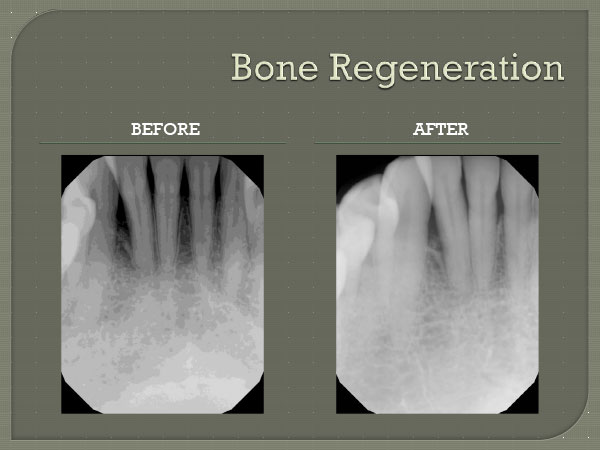 Bone Regeneration Pembroke Pines