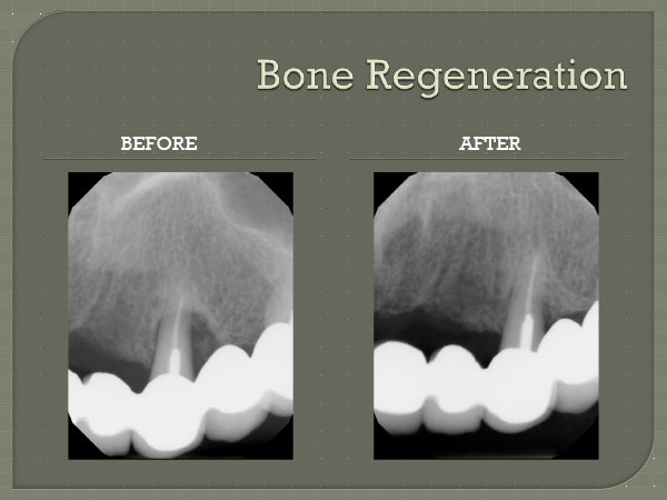 Bone Regeneration Cooper City