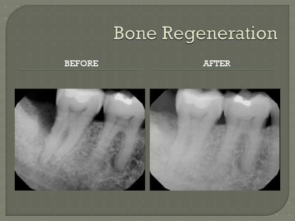 Bone Regeneration Services Pembroke Pines
