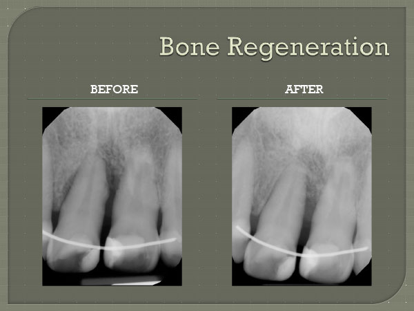 Pembroke Pines Bone Regeneration Repair