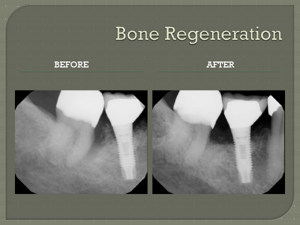 Bone Regeneration Repair Cooper City