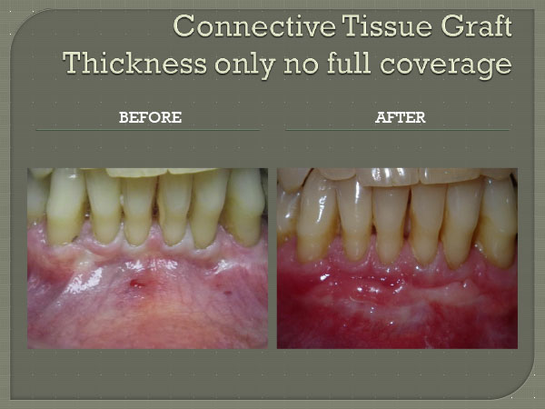 Connective Tissue Graft Coverage