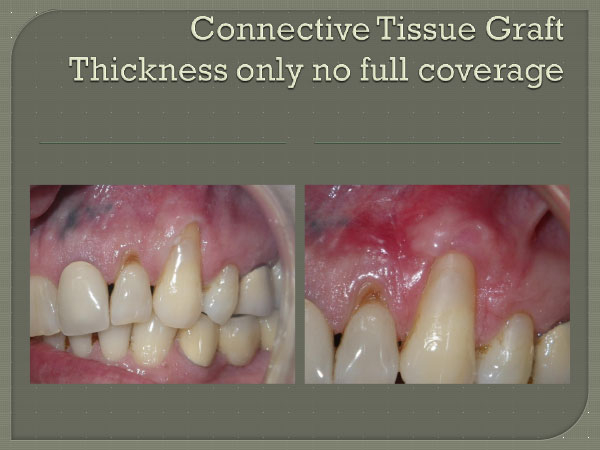 Connective Tissue Graft Thickness Only