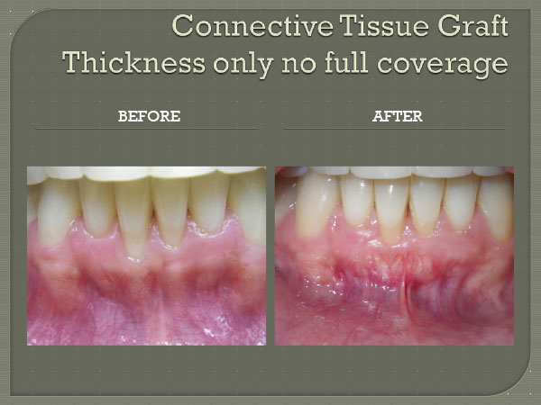 Connective Tissue Graft Thickness Only