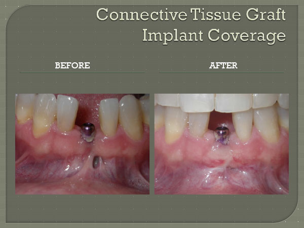Connective Tissue Graft Implant Coverage
