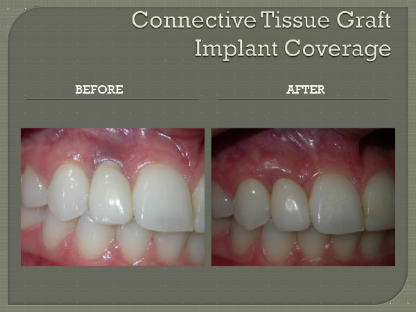 Connective Tissue Graft Implant Coverage